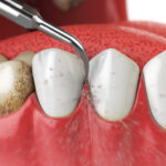 Tooth Story Pediatric Dentistry | Can Kids' Cavities Be Treated Without Drilling? A Guide to Minimally Invasive Pediatric Dentistry