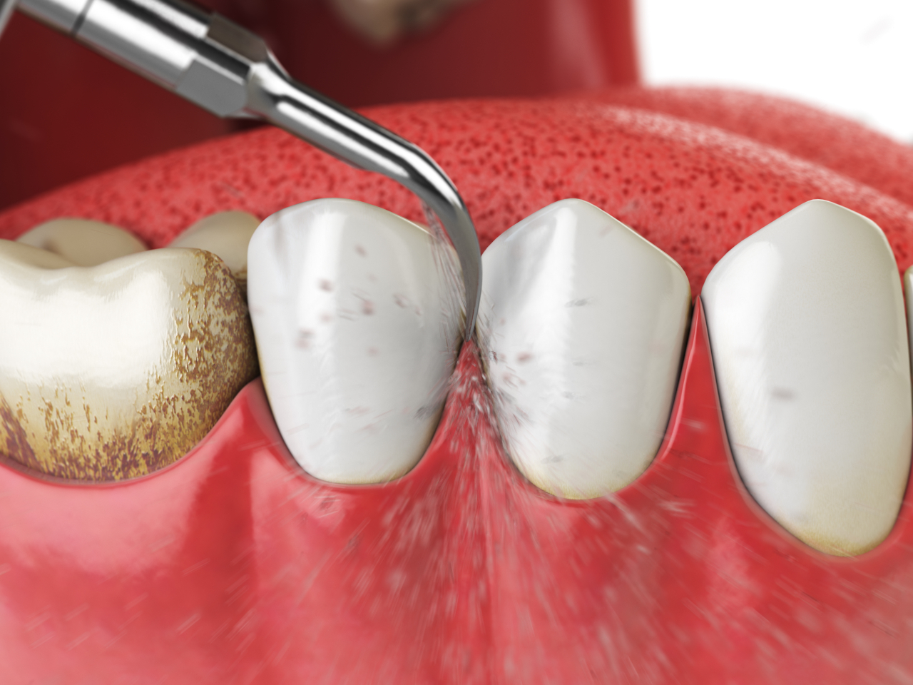 Tooth Story Pediatric Dentistry | Can Kids' Cavities Be Treated Without Drilling? A Guide to Minimally Invasive Pediatric Dentistry